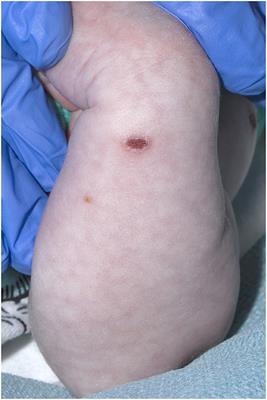 Case Report: Neonatal Varicella Acquired From Maternal Zoster